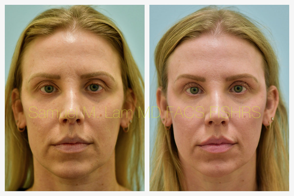Blepharoplasty, eyelid rejuvenation Before and After Photo by Dr. Lam in Plano, TX