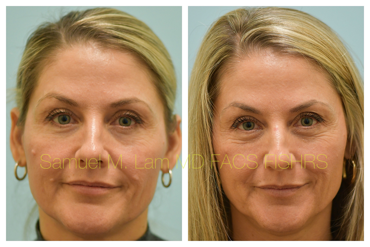 mole removal