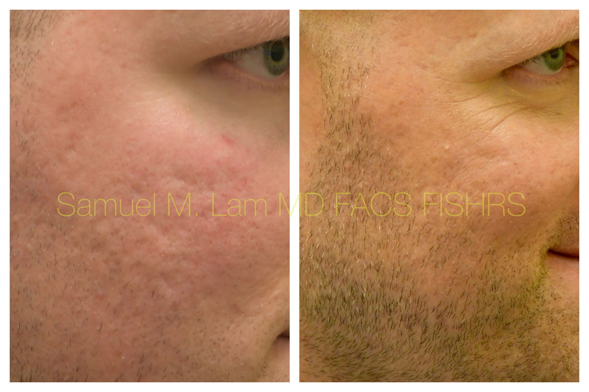 Acne Scarring and MesoBotox Before and After Photo by Dr. Lam in Plano, TX