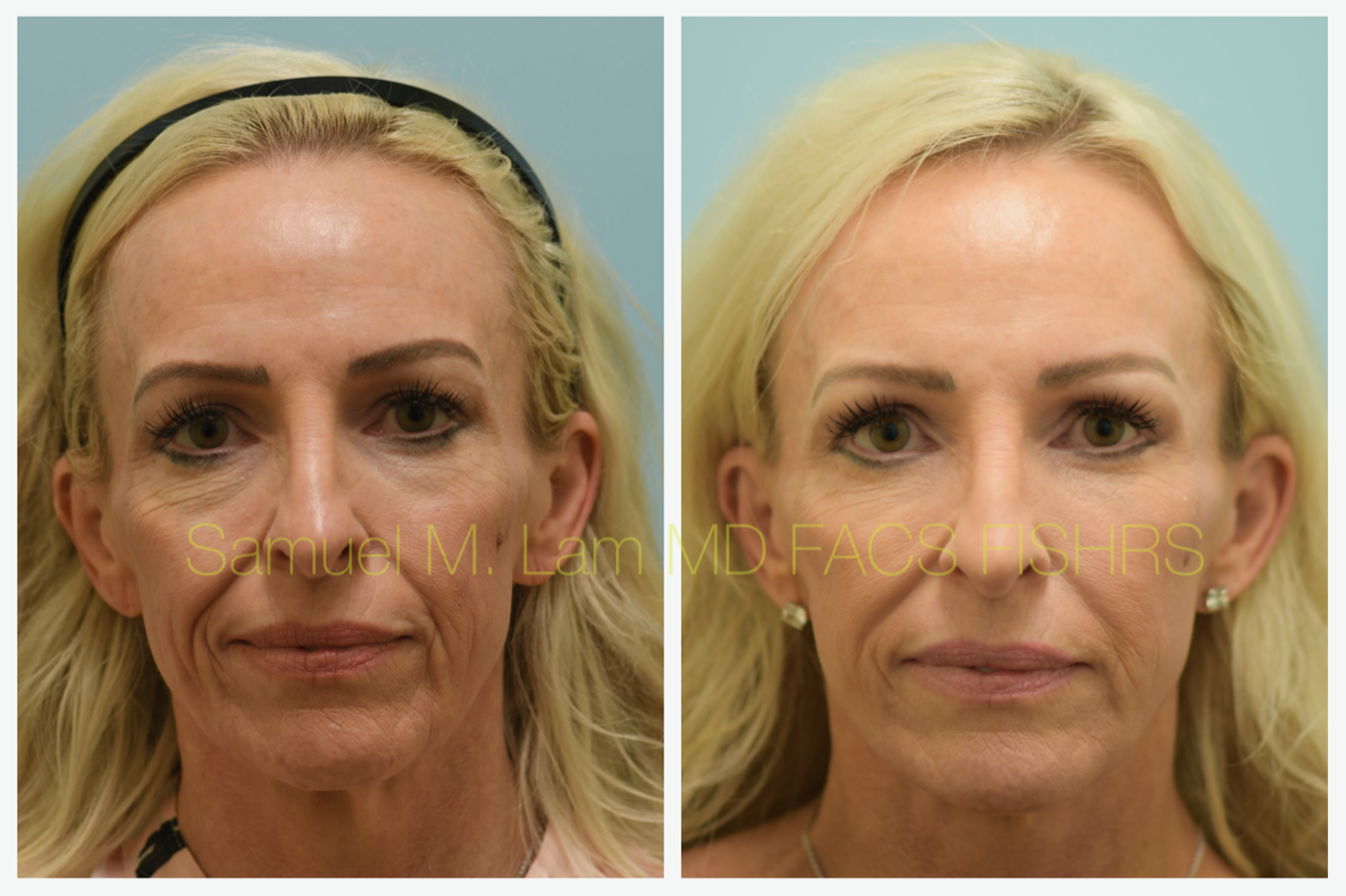 Facelift Blepharopalsty Fat Grafting Before and After Photo by Dr. Lam in Plano, TX