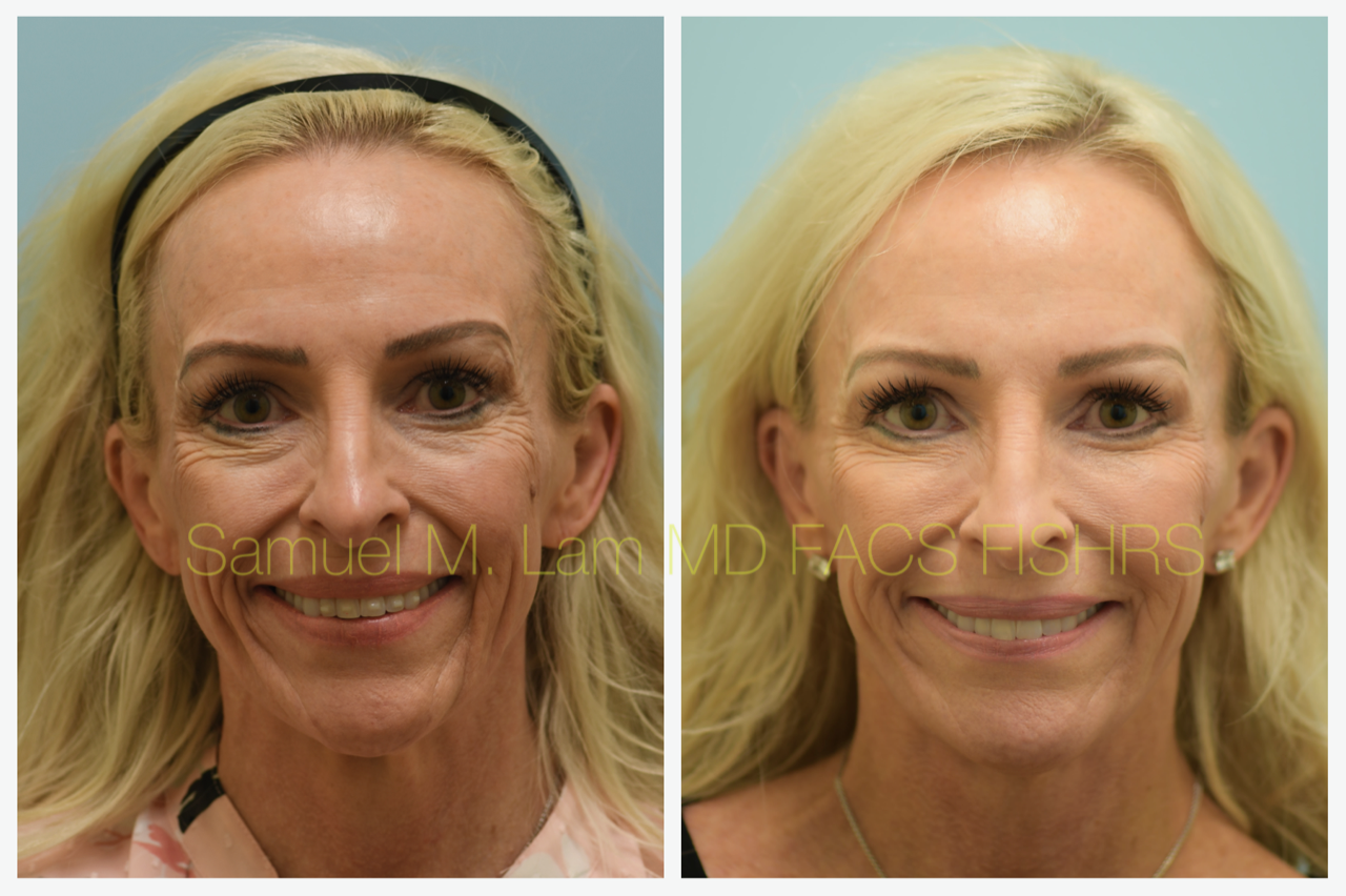 Facelift Blepharopalsty Fat Grafting Before and After Photo by Dr. Lam in Plano, TX