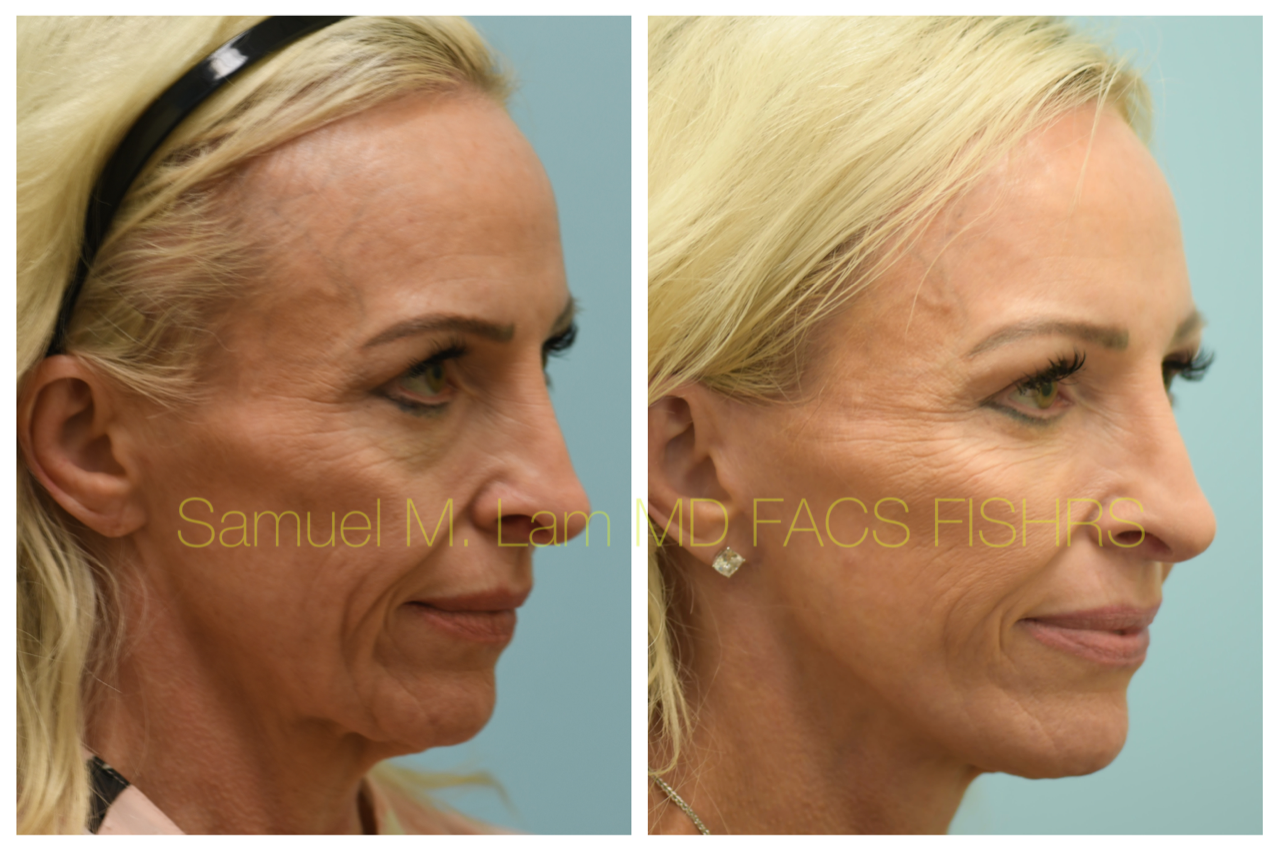 Facelift Blepharopalsty Fat Grafting Before and After Photo by Dr. Lam in Plano, TX