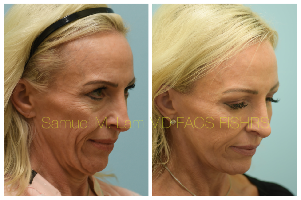 Facelift Blepharopalsty Fat Grafting Before and After Photo by Dr. Lam in Plano, TX