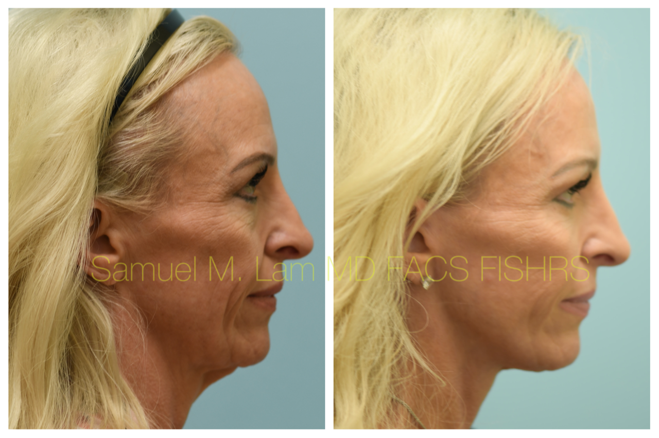 Facelift Blepharopalsty Fat Grafting Before and After Photo by Dr. Lam in Plano, TX