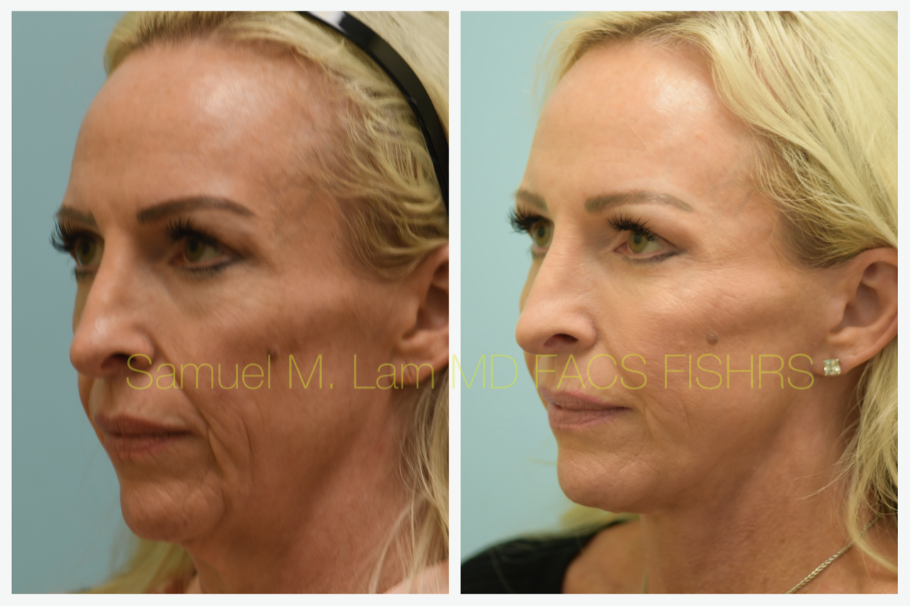Facelift Blepharopalsty Fat Grafting Before and After Photo by Dr. Lam in Plano, TX