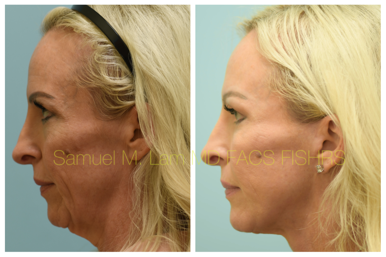 Facelift Blepharopalsty Fat Grafting Before and After Photo by Dr. Lam in Plano, TX