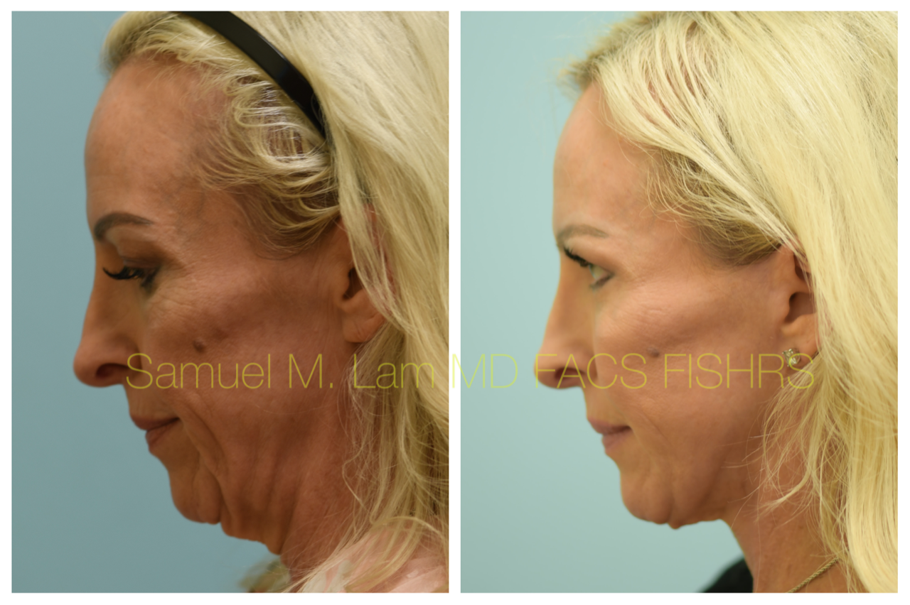 Facelift Blepharopalsty Fat Grafting Before and After Photo by Dr. Lam in Plano, TX