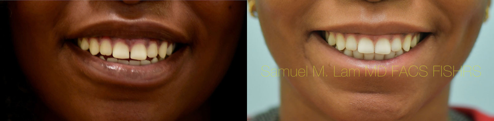 Lip Reduction Before and After Photo by Dr. Lam in Plano, TX