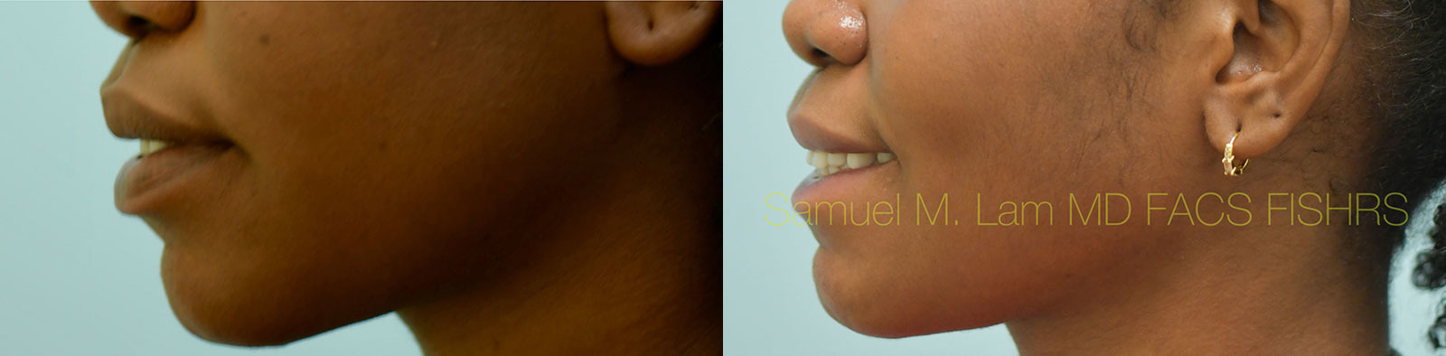 Lip Reduction Before and After Photo by Dr. Lam in Plano, TX