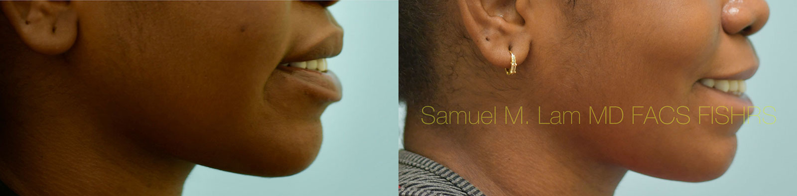 Lip Reduction Before and After Photo by Dr. Lam in Plano, TX
