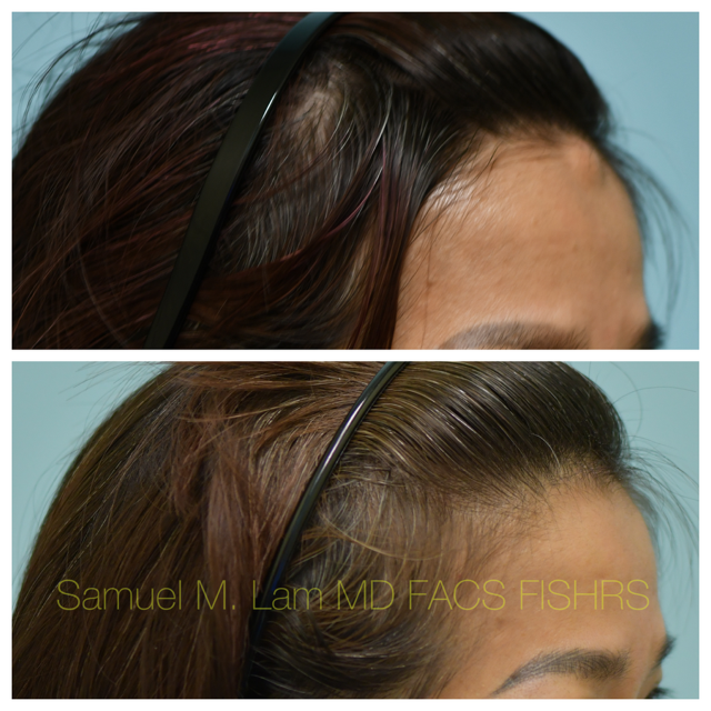 Osteoma Before and After Photo by Dr. Lam in Plano, TX