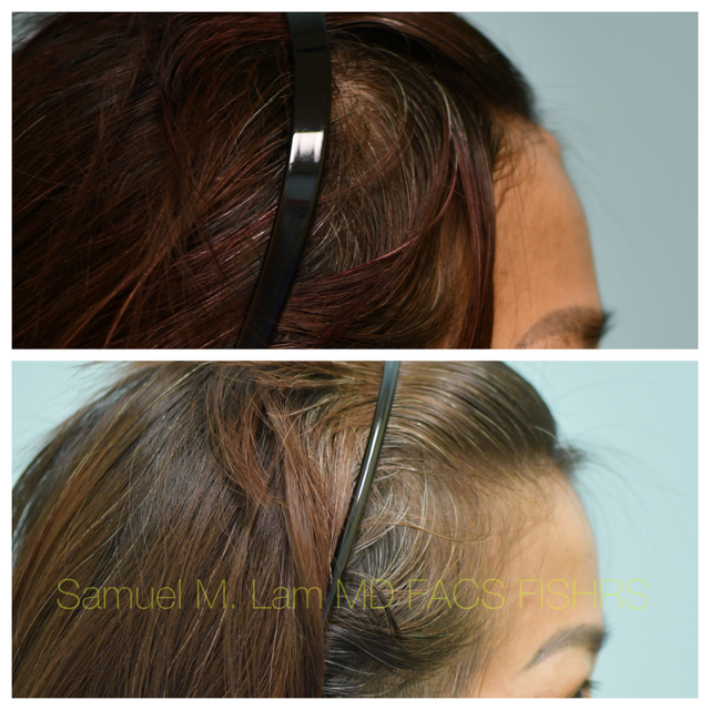 Osteoma Before and After Photo by Dr. Lam in Plano, TX