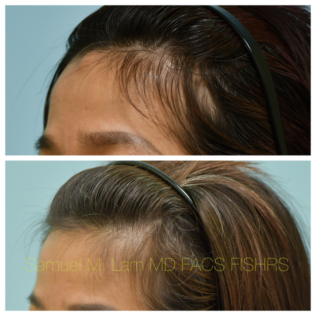 Osteoma Before and After Photo by Dr. Lam in Plano, TX