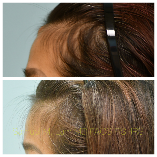Osteoma Before and After Photo by Dr. Lam in Plano, TX