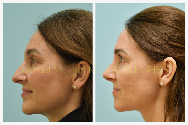 Rhinoplasty Before and After Photo by Dr. Lam in Plano, TX
