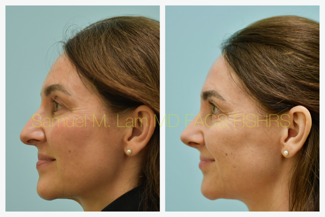 Rhinoplasty Before and After Photo by Dr. Lam in Plano, TX