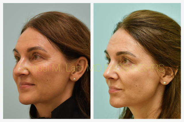Rhinoplasty Before and After Photo by Dr. Lam in Plano, TX