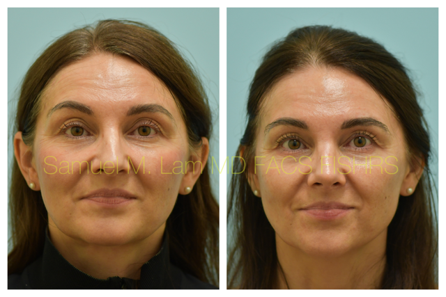 Rhinoplasty Before and After Photo by Dr. Lam in Plano, TX