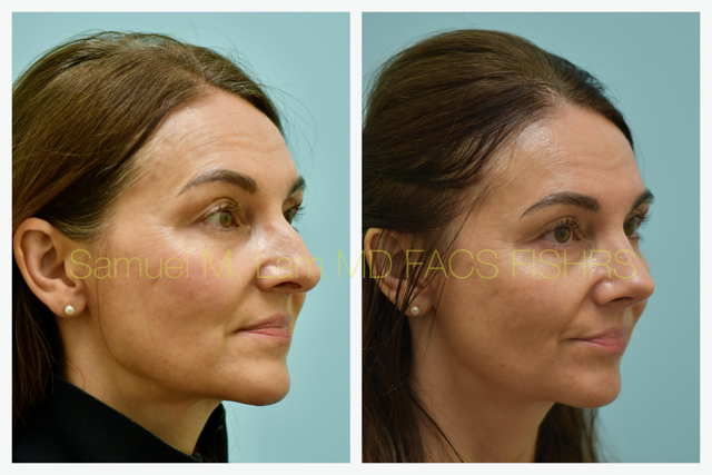Rhinoplasty Before and After Photo by Dr. Lam in Plano, TX