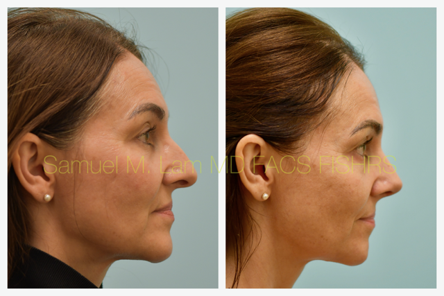 Rhinoplasty Before and After Photo by Dr. Lam in Plano, TX