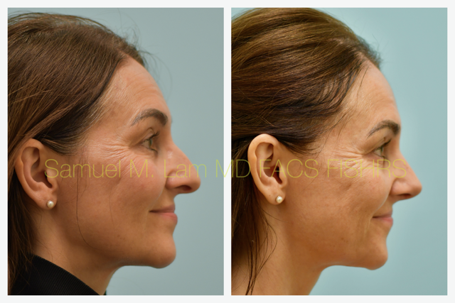 Rhinoplasty Before and After Photo by Dr. Lam in Plano, TX