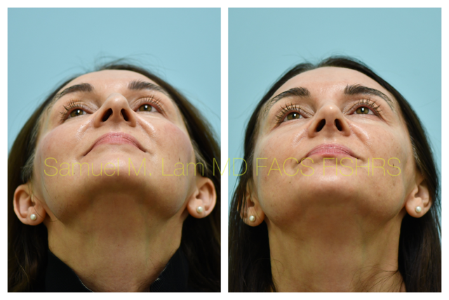 Rhinoplasty Before and After Photo by Dr. Lam in Plano, TX