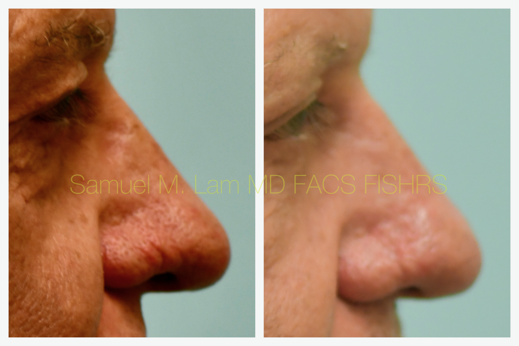 Rhinopyma Before and After Photo by Dr. Lam in Plano, TX