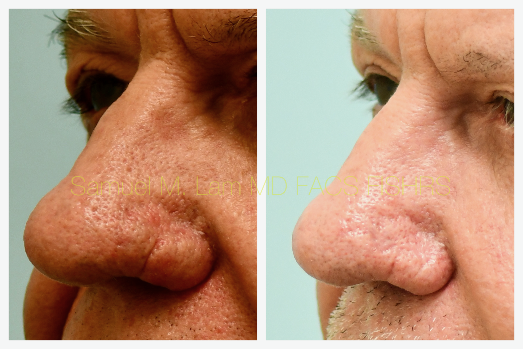 Rhinopyma Before and After Photo by Dr. Lam in Plano, TX