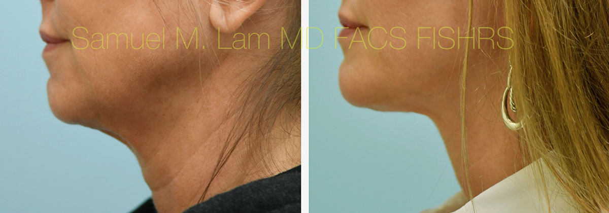 Face:Necklift Before and After Photo by Dr. Lam in Plano, TX