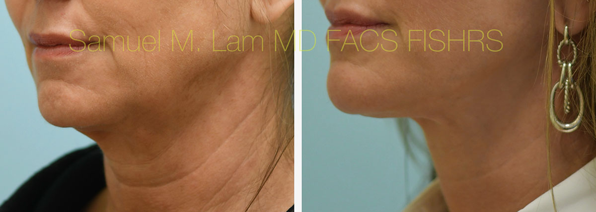 Face:Necklift Before and After Photo by Dr. Lam in Plano, TX