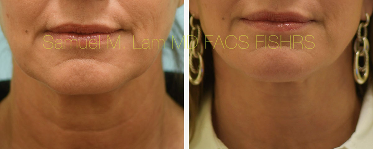 Face:Necklift Before and After Photo by Dr. Lam in Plano, TX