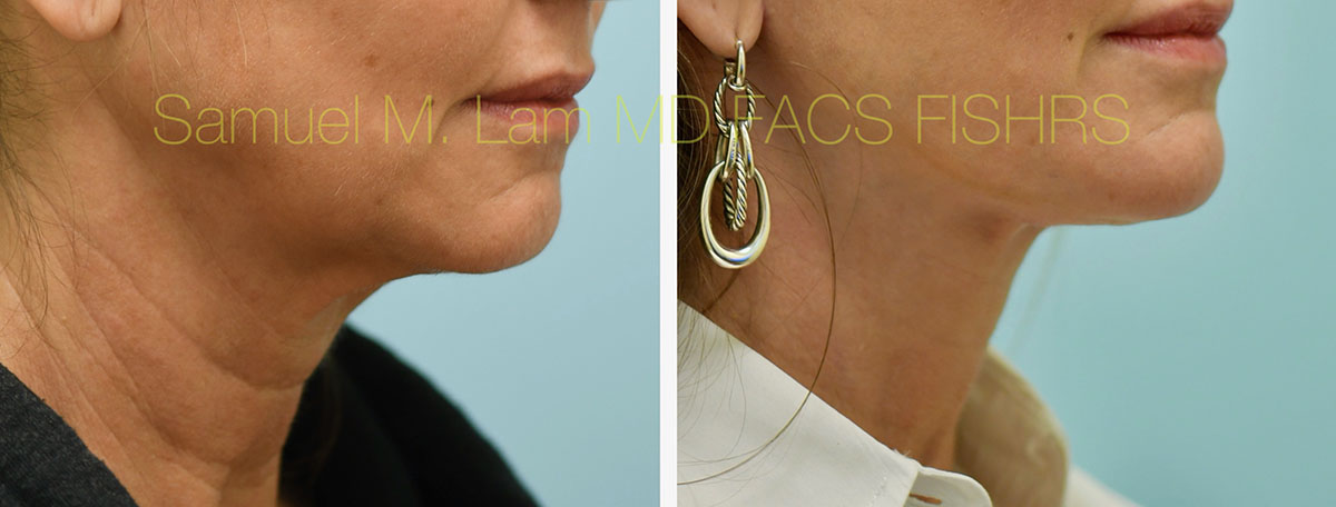 Face:Necklift Before and After Photo by Dr. Lam in Plano, TX