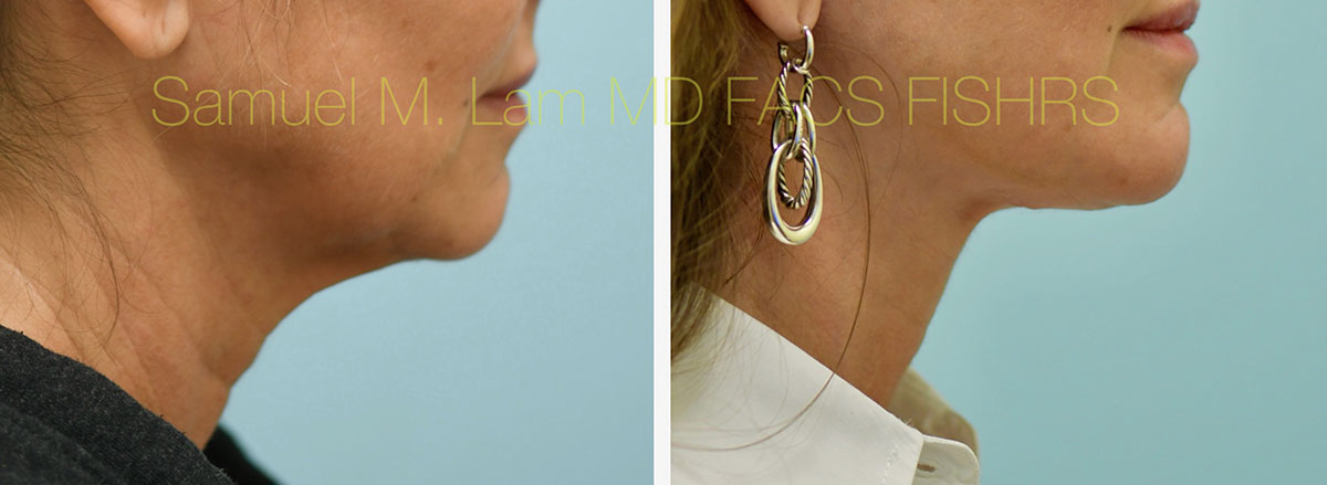 Face:Necklift Before and After Photo by Dr. Lam in Plano, TX