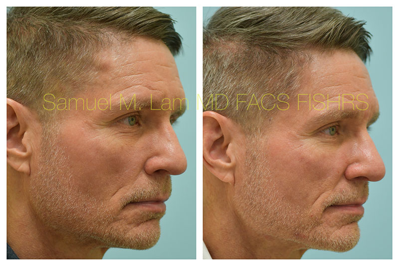 Osteoma Before and After Photo by Dr Lam in Plano TX