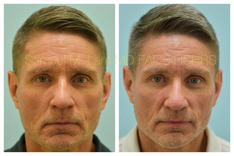 Osteoma Before and After Photo by Dr Lam in Plano TX