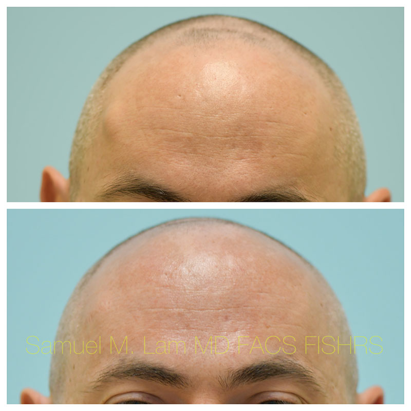 Osteoma Before and After Photo by Dr Lam in Plano TX