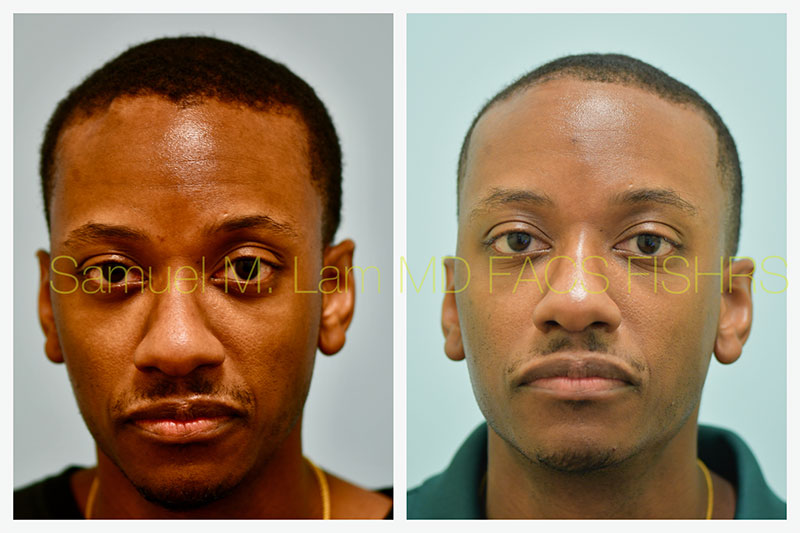 Osteoma Before and After Photo by Dr Lam in Plano TX