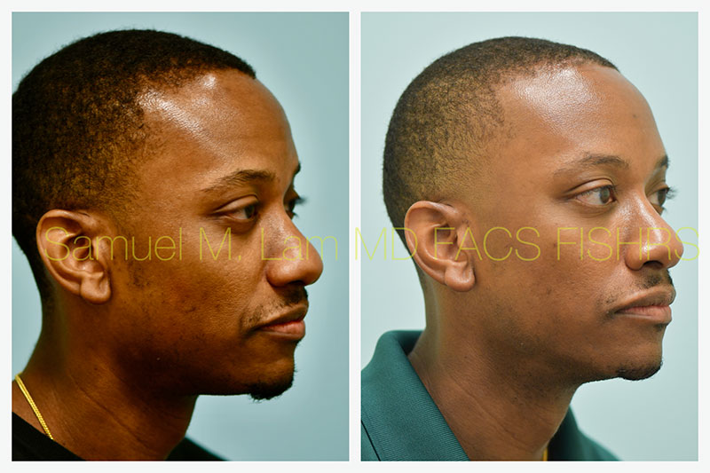 Osteoma Before and After Photo by Dr Lam in Plano TX