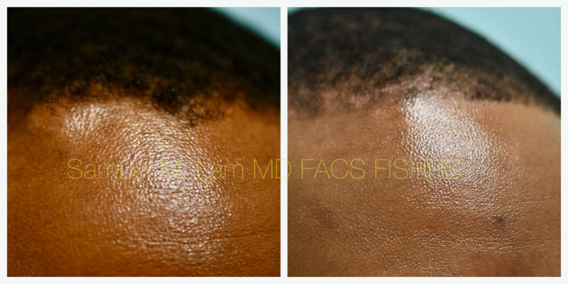 Osteoma Before and After Photo by Dr Lam in Plano TX