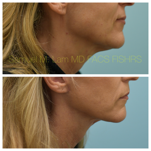 Facelift Before and After Photo by Dr. Lam in Plano, TX