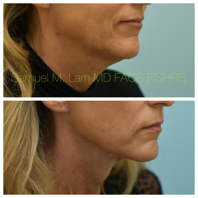 Facelift Before and After Photo by Dr. Lam in Plano, TX