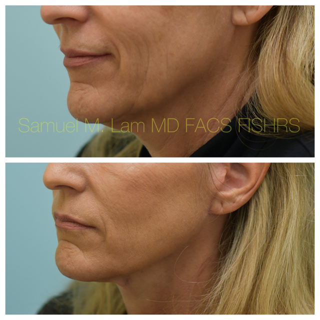 Facelift Before and After Photo by Dr. Lam in Plano, TX