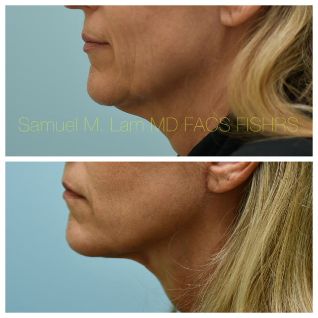 Facelift Before and After Photo by Dr. Lam in Plano, TX