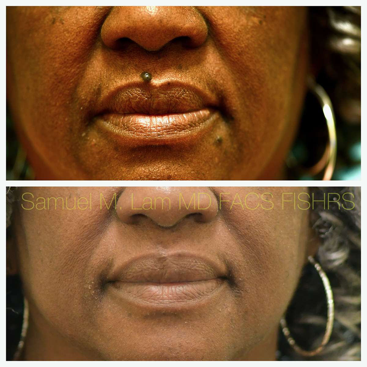 Mole Removal Before and After Photo by Dr. Lam in Plano, TX