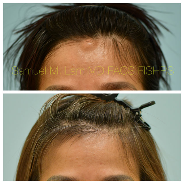 Osteoma Before and After Photo by Dr. Lam in Plano TX