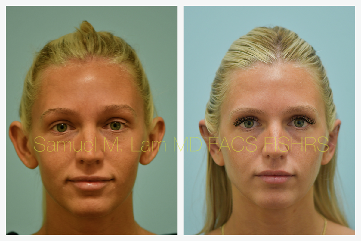 Otoplasty Before and After Photo by Dr. Lam in Plano, TX