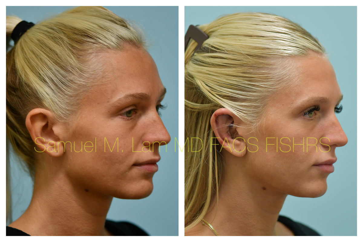 Otoplasty Before and After Photo by Dr. Lam in Plano, TX