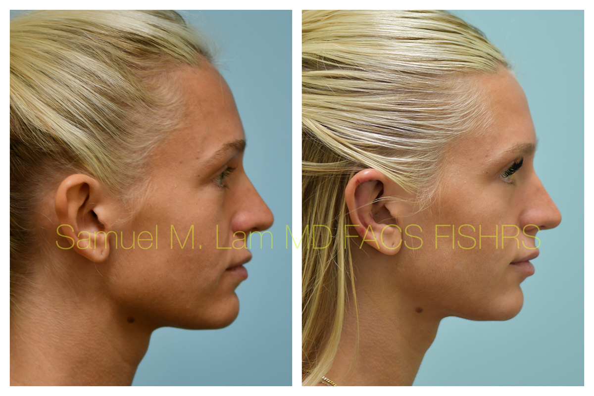 Otoplasty Before and After Photo by Dr. Lam in Plano, TX