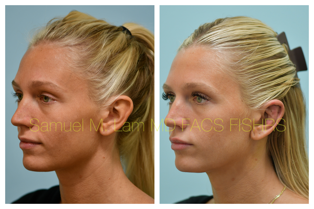 Otoplasty Before and After Photo by Dr. Lam in Plano, TX