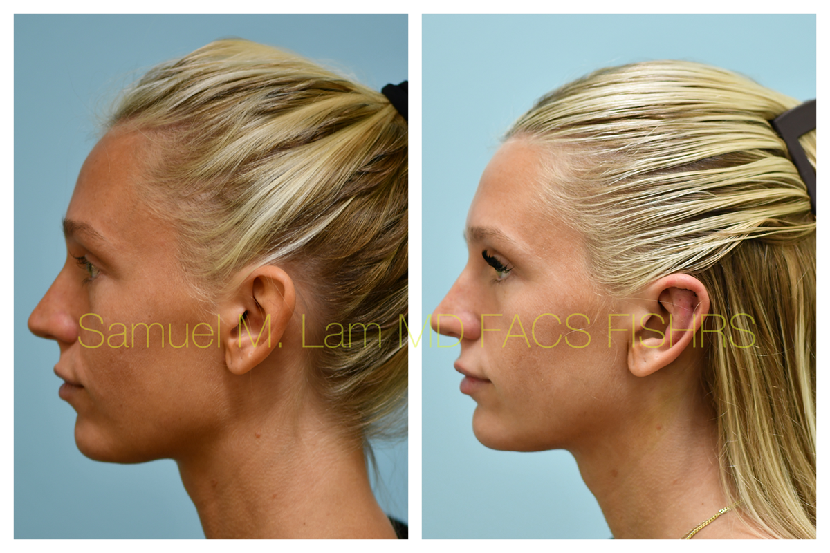 Otoplasty Before and After Photo by Dr. Lam in Plano, TX